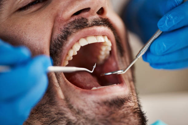 Best Emergency Tooth Extraction in Whitewater, WI
